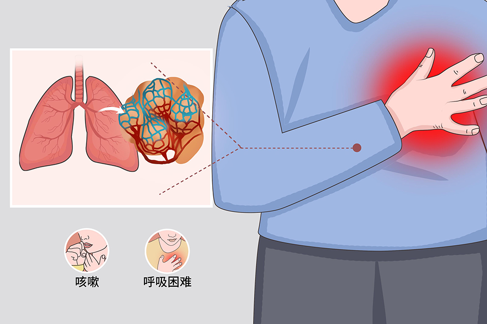 肺纖維化-肺炎-吸煙-特發(fā)性肺纖維化-肺功能-肺功能檢測儀-呼吸訓練器-慢阻肺-哮喘-免疫力-咽炎-咳嗽-干咳-呼吸肌